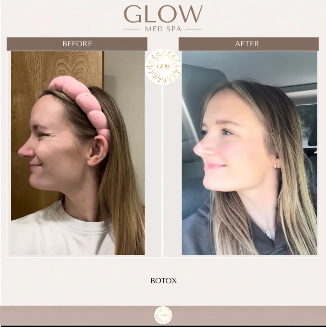 Before and after Botox, side view of the eye area