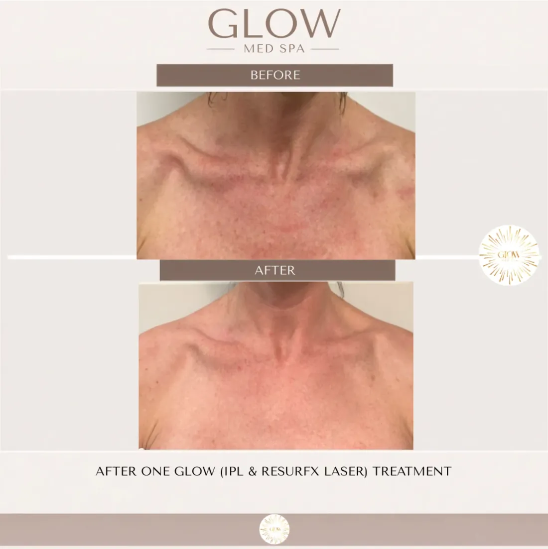 Before and after one IPL and ResurFX laser treatment on the chest