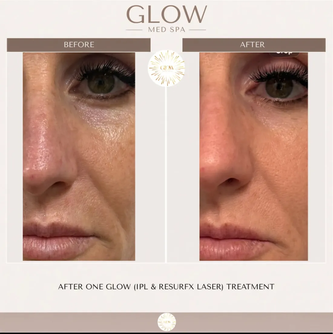 Before and after one IPL and ResurFX laser treatment