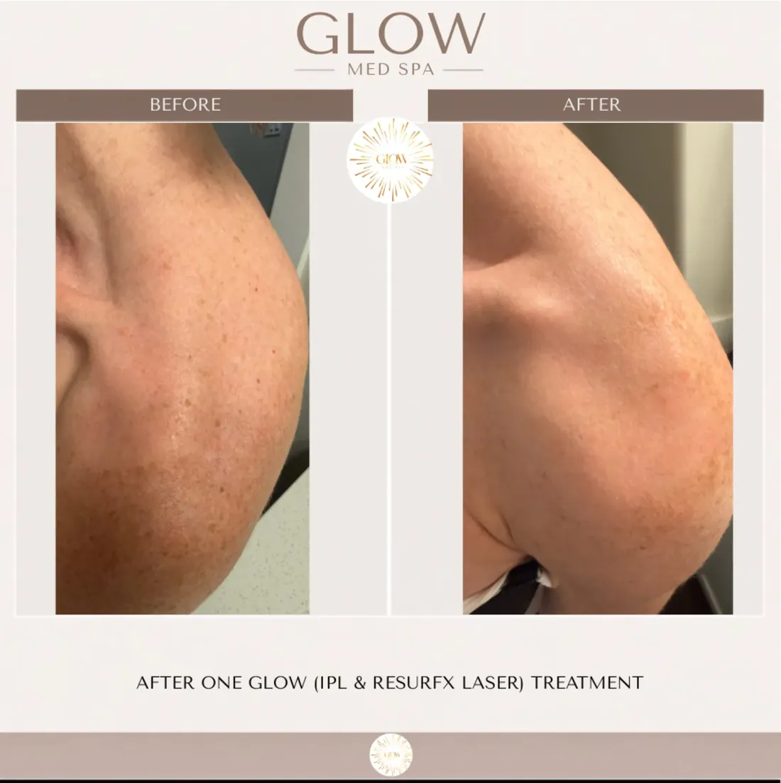 Before and after one IPL and ResurFX laser treatment on the shoulder