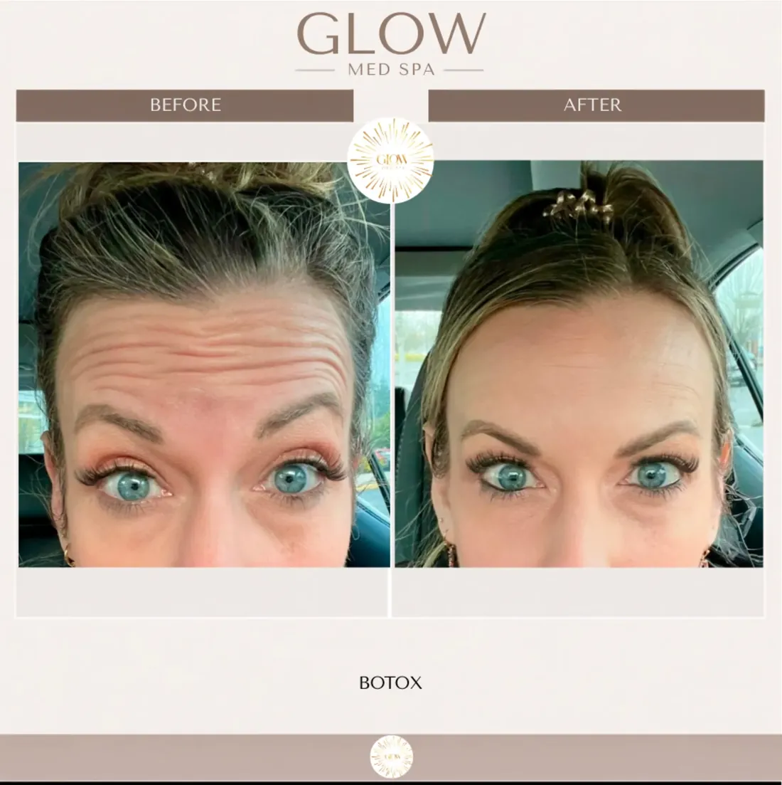 Before and after Botox for forehead lines