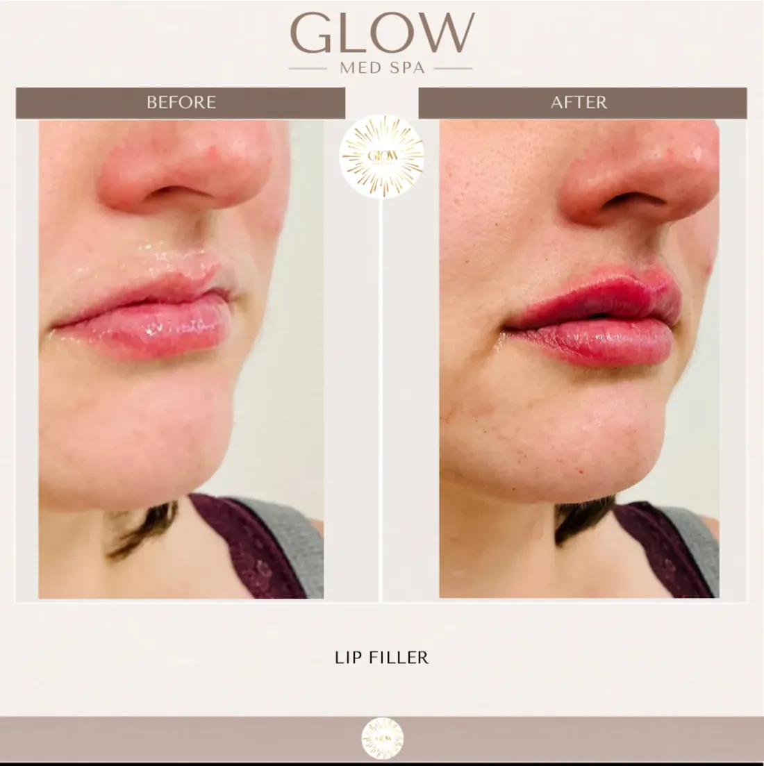 Before and after lip filler, side view
