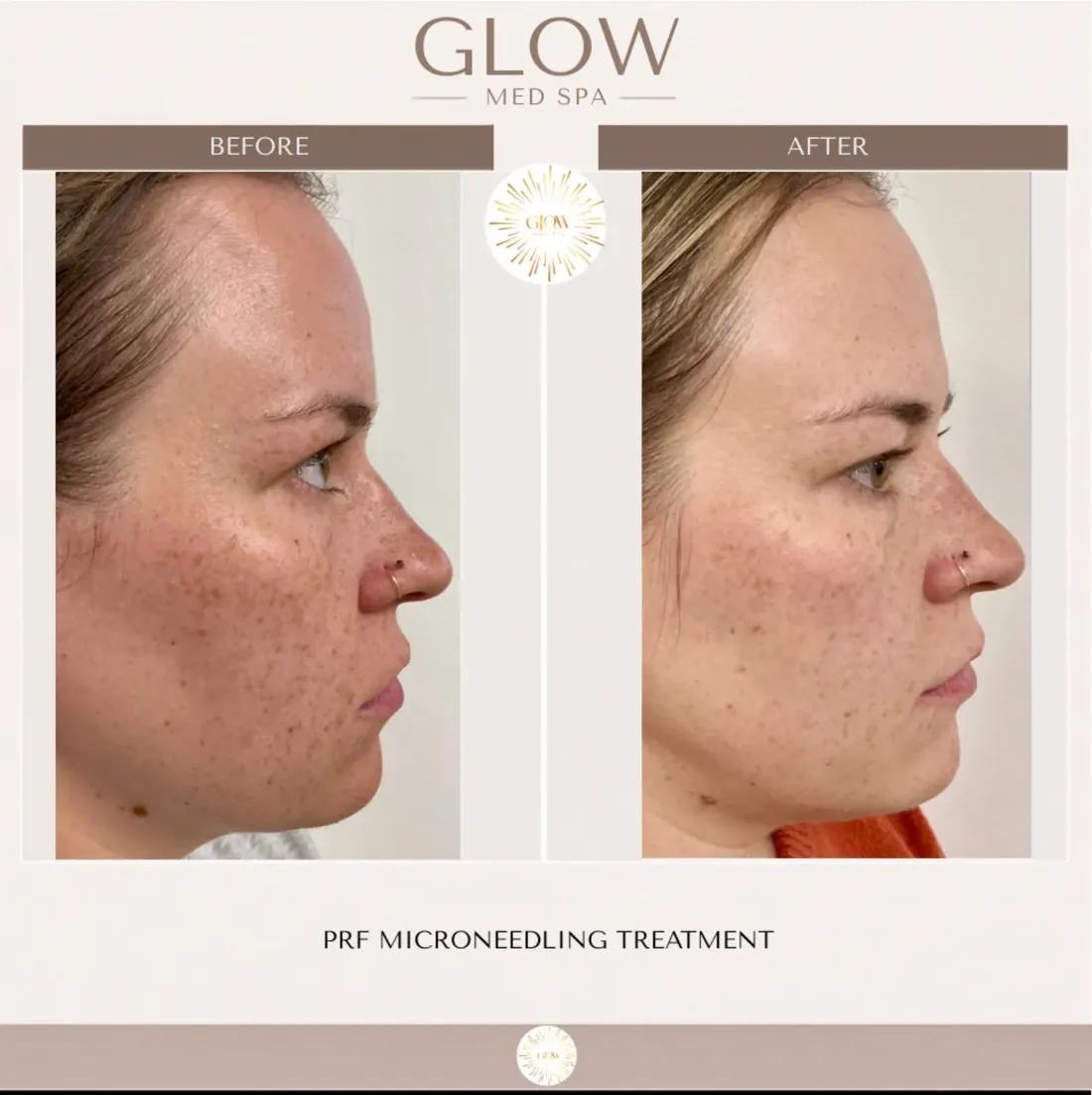 Before and after PRF microneedling, side profile