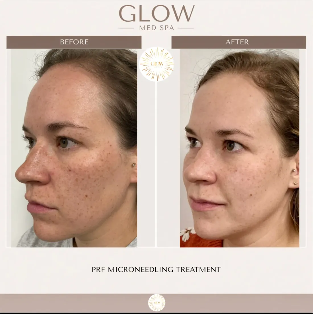 Before and after PRF microneedling for skin texture and tone
