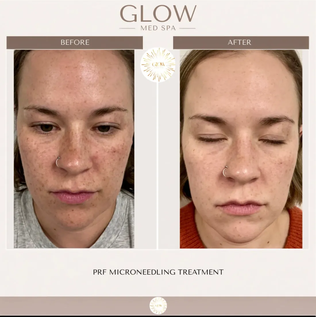 Before and after PRF microneedling, front view