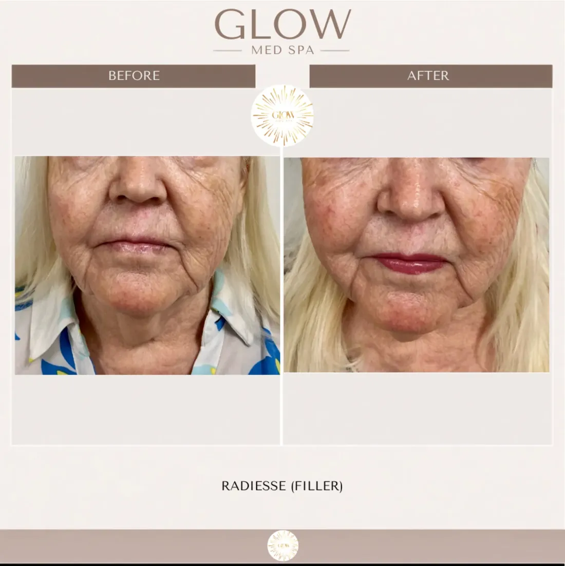 Before and after Radiesse filler, front view