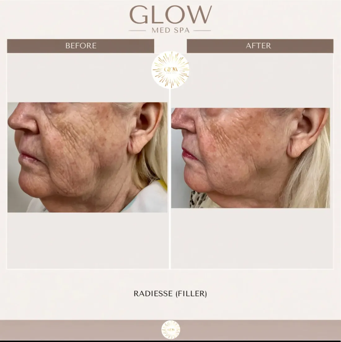 Before and after Radiesse filler along the jaw, side view