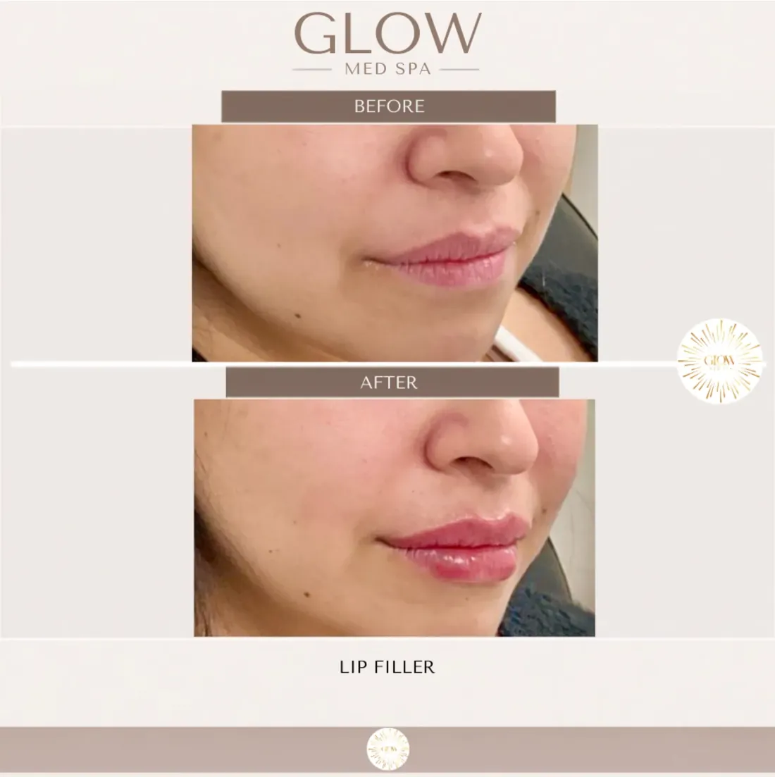 Before and after lip filler, close up