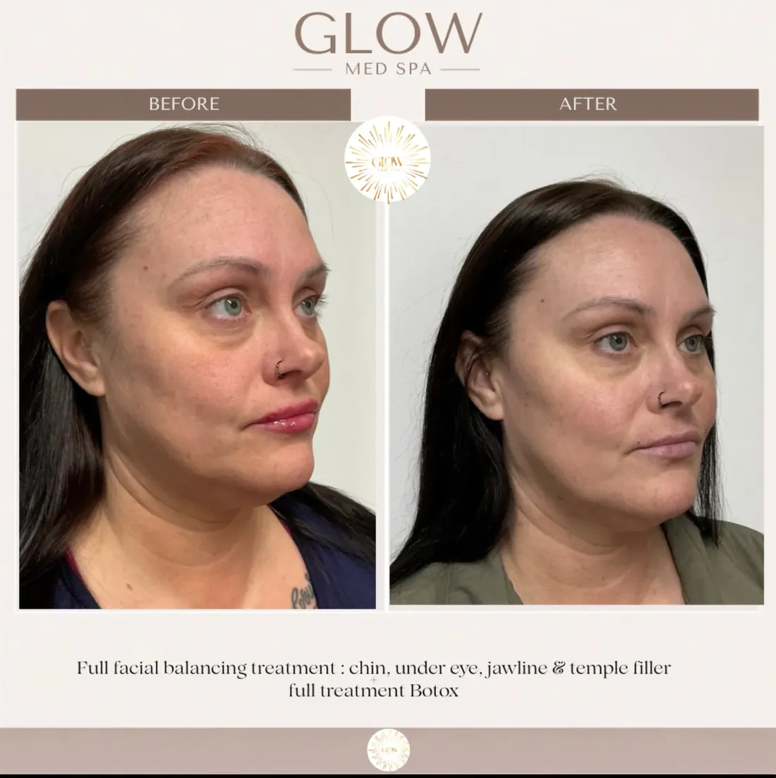 Before and after full facial balancing with chin, under-eye, jawline and temple filler plus Botox