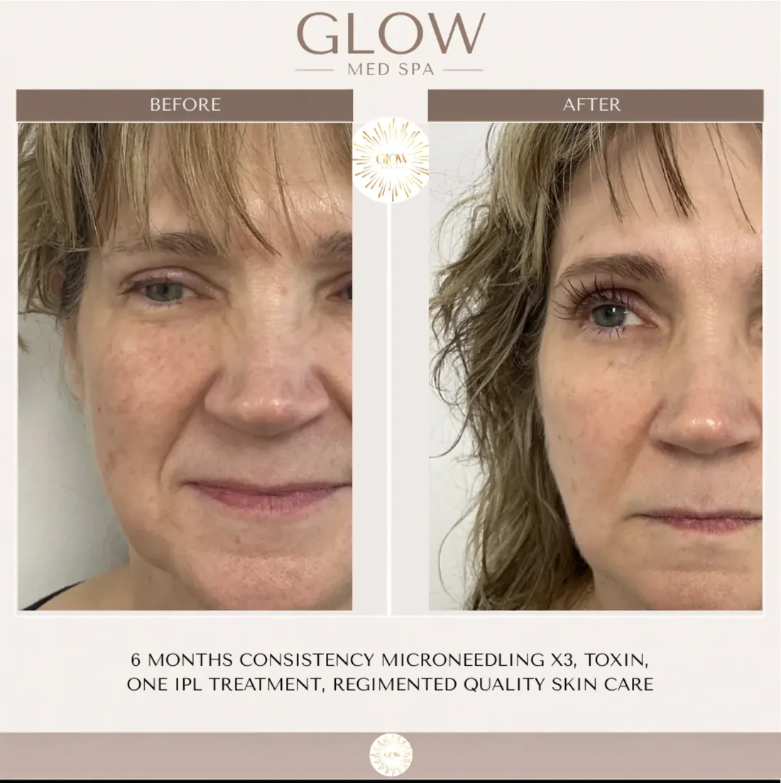 Before and after six months of microneedling, Botox, one IPL and medical-grade skin care
