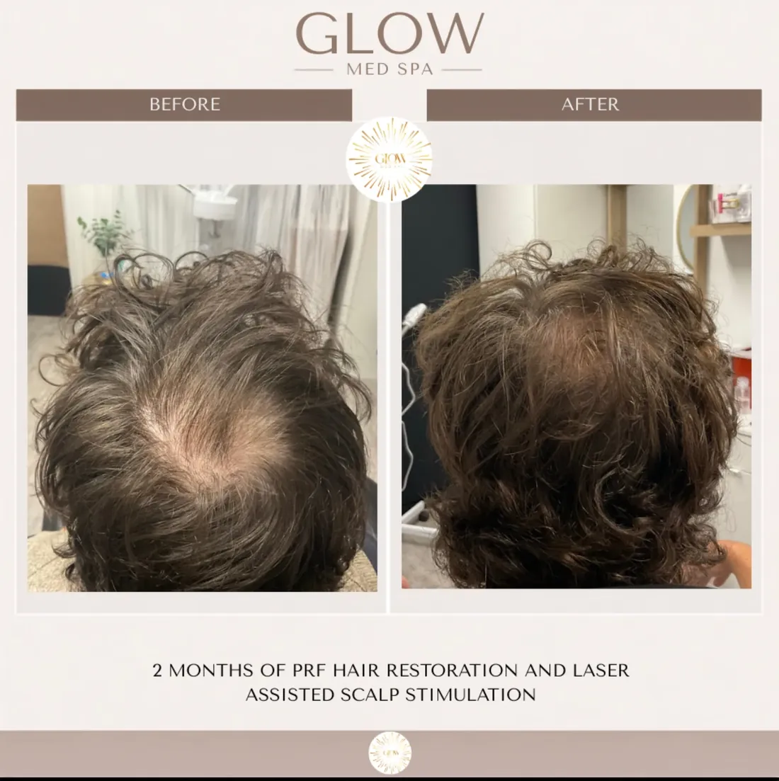 Before and after 2 months of PRF hair restoration with laser scalp stimulation