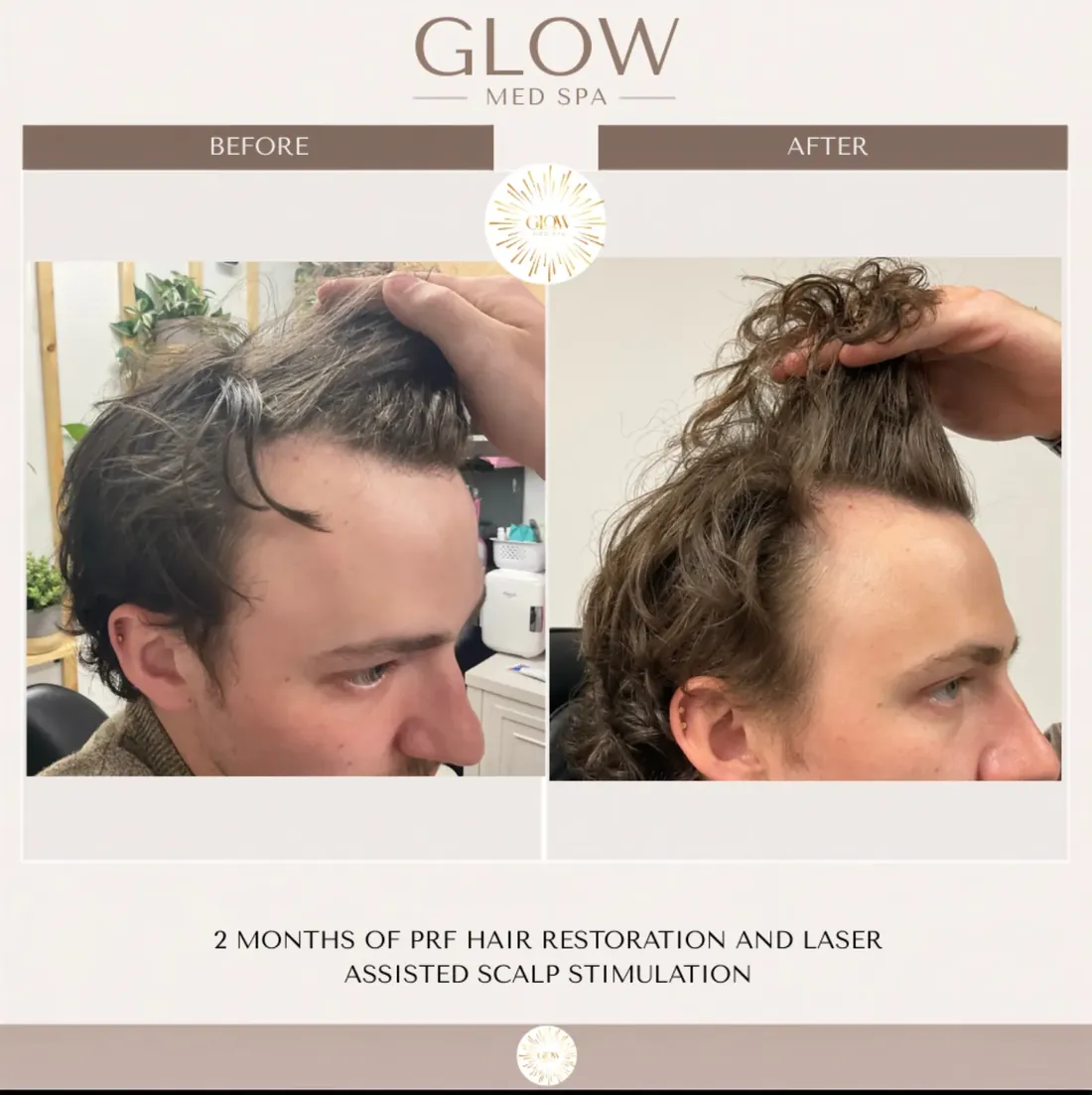 Hairline before and after 2 months of PRF hair restoration