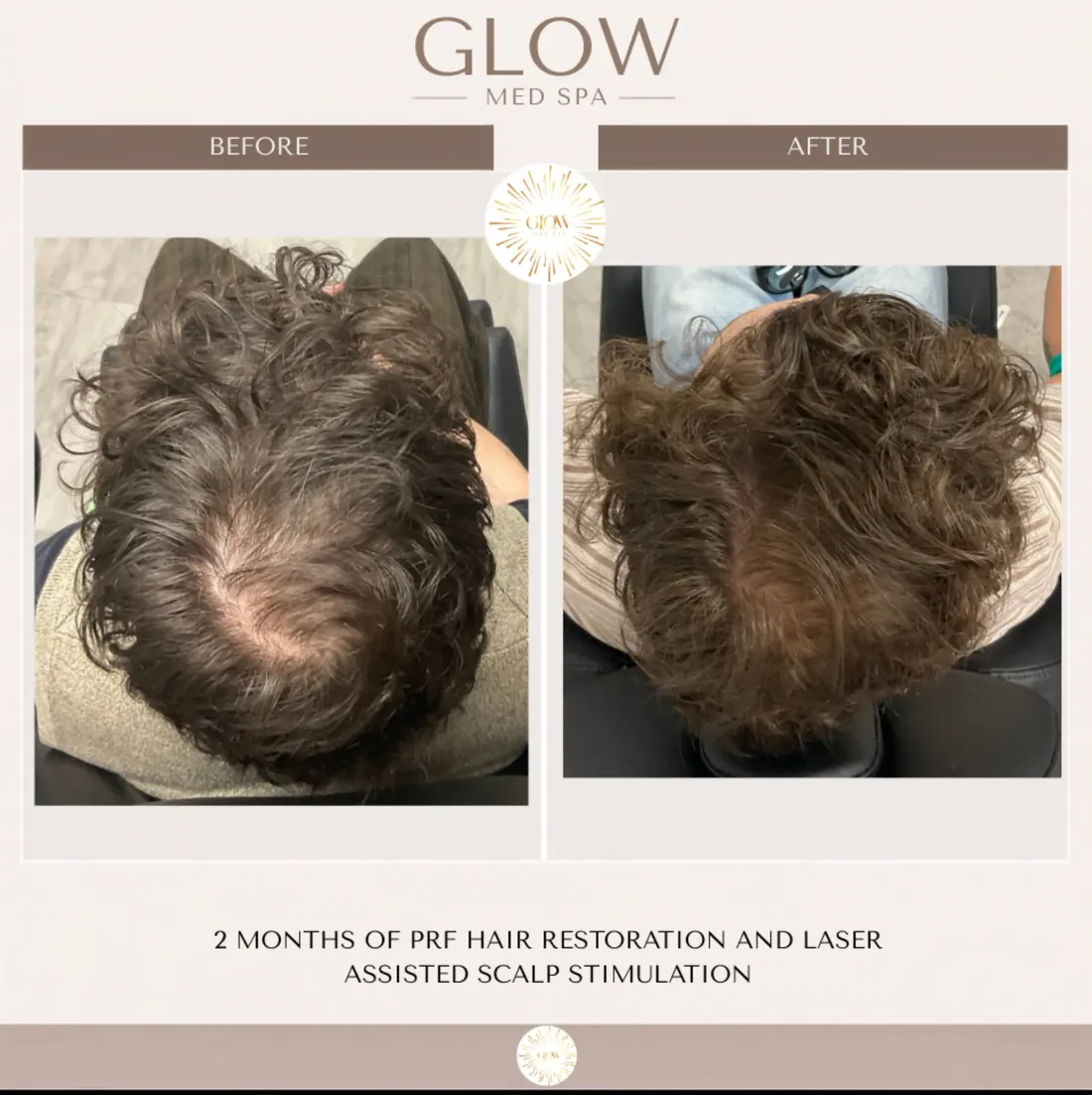 Crown before and after 2 months of PRF hair restoration