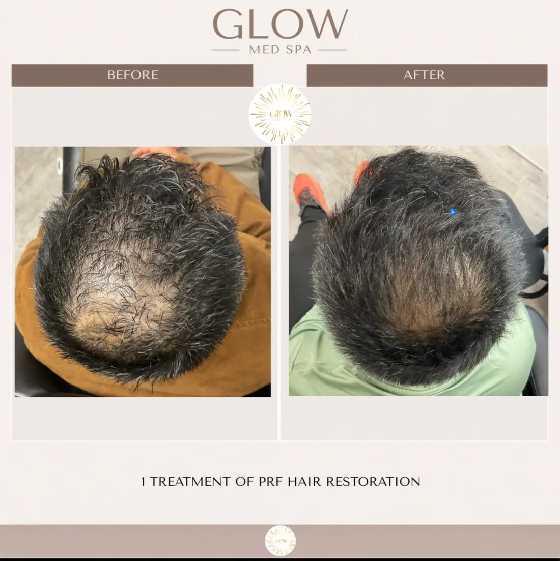 Crown before and after one PRF hair restoration treatment