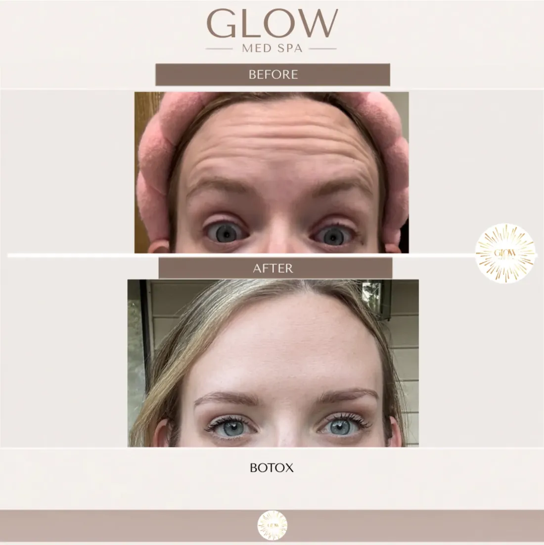 Before and after Botox for forehead lines, front view