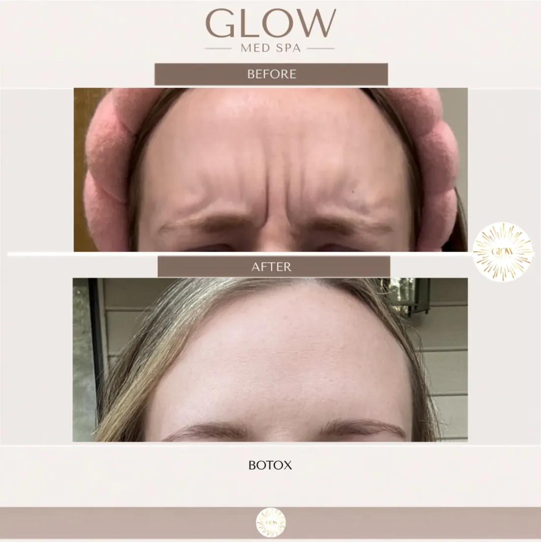 Before and after Botox for frown lines between the brows