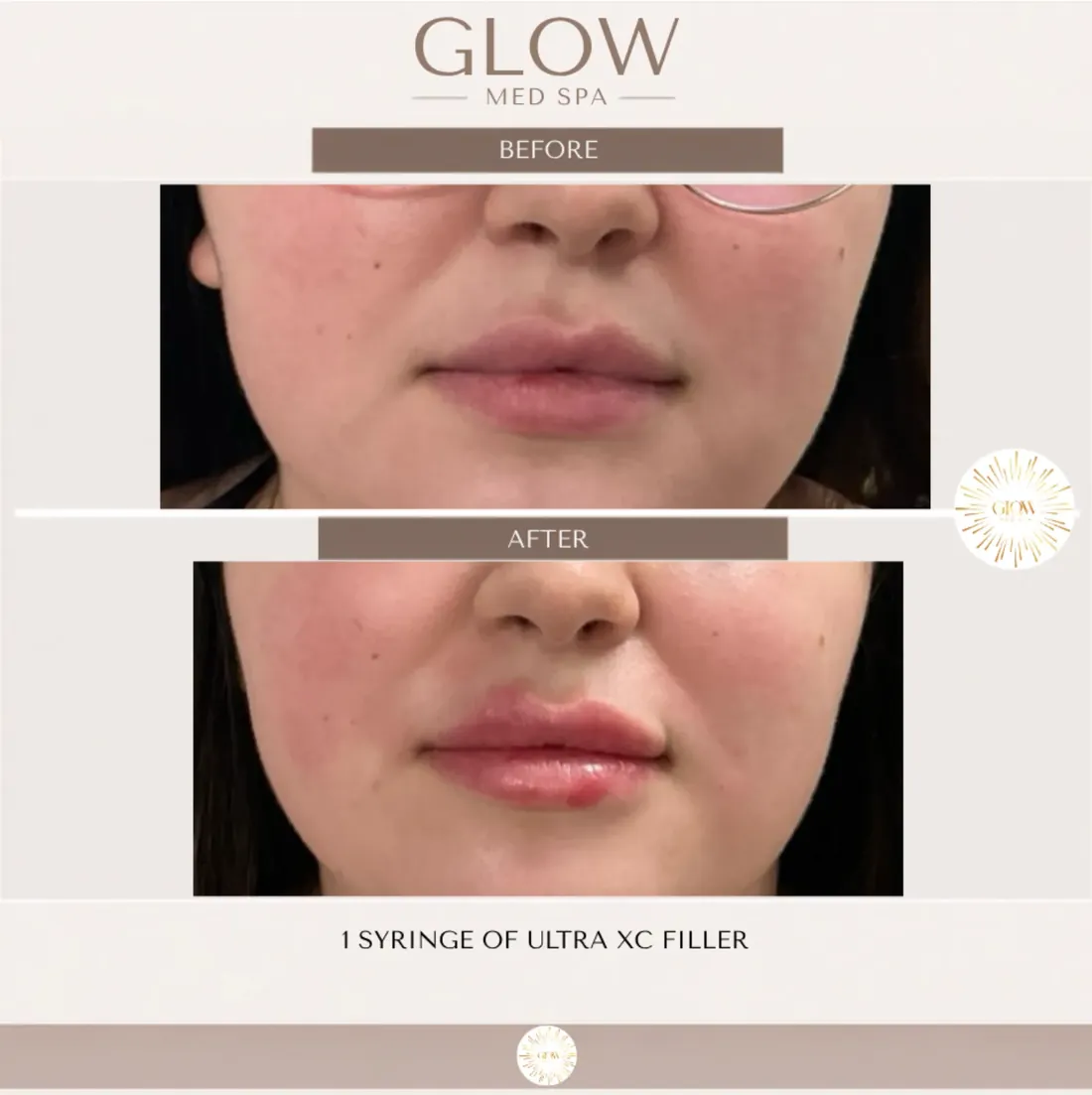 Before and after one syringe of Ultra XC lip filler