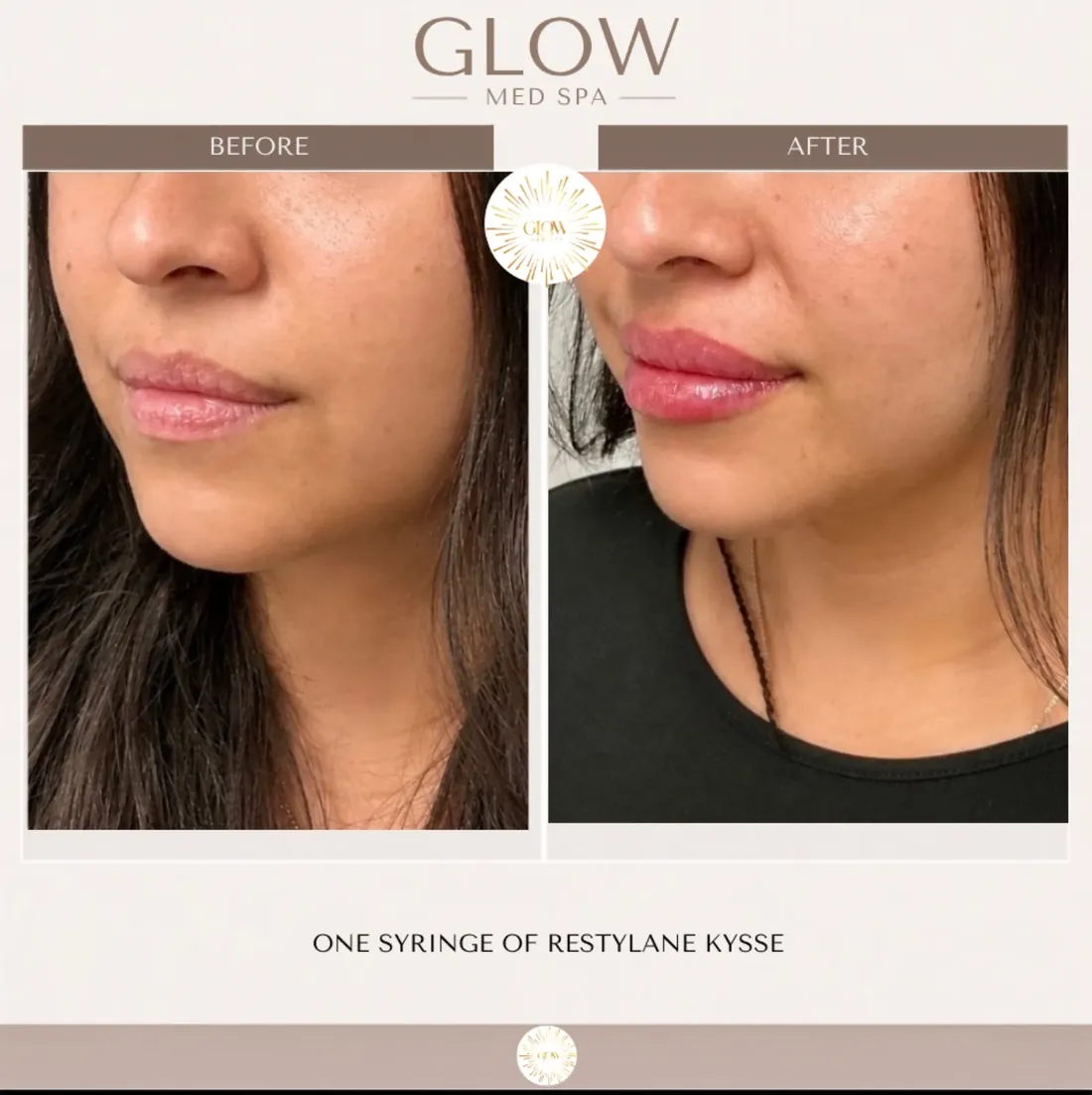 Before and after one syringe of Restylane Kysse