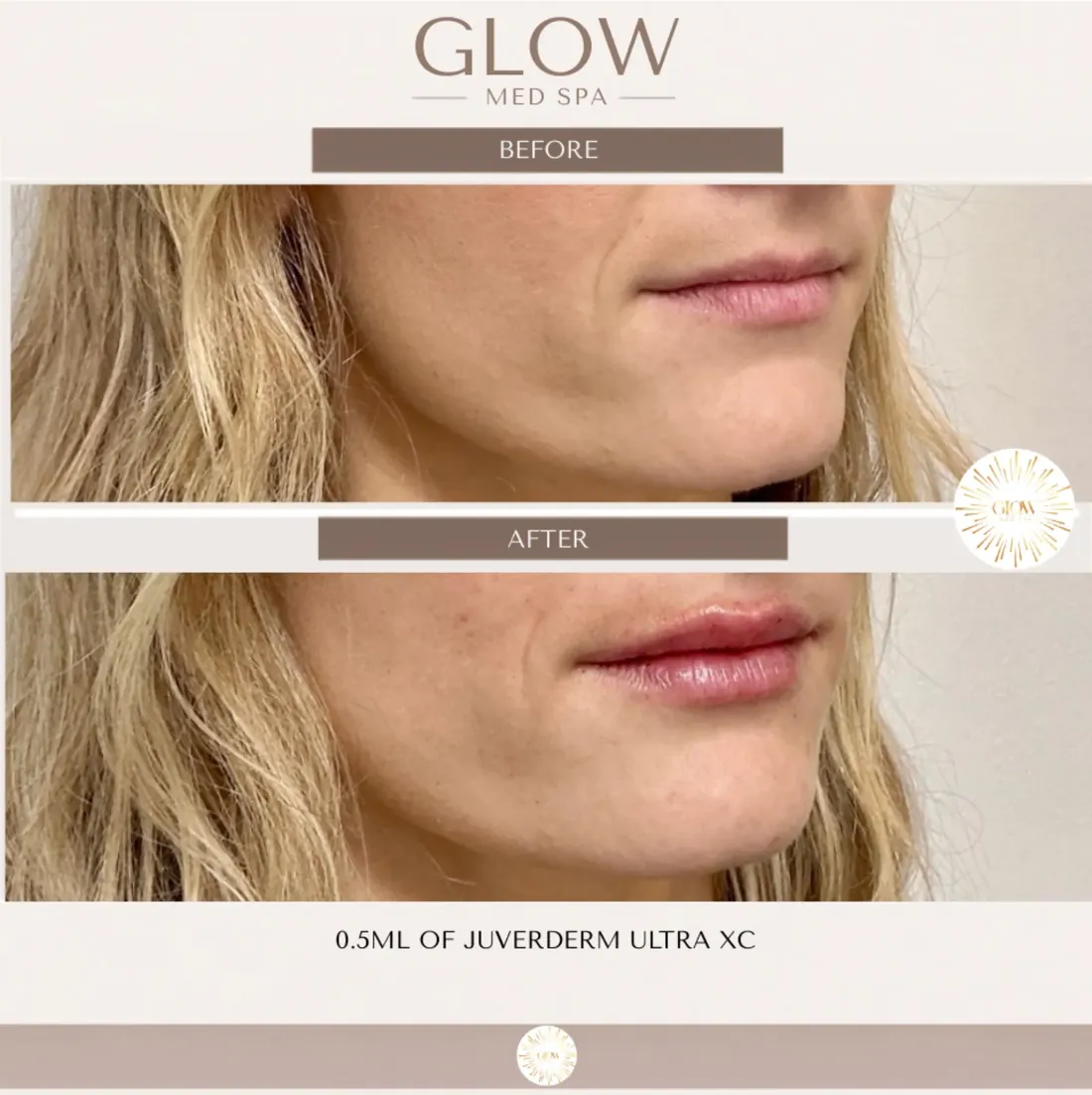 Before and after lip filler with 0.5 ml of Juvederm Ultra XC
