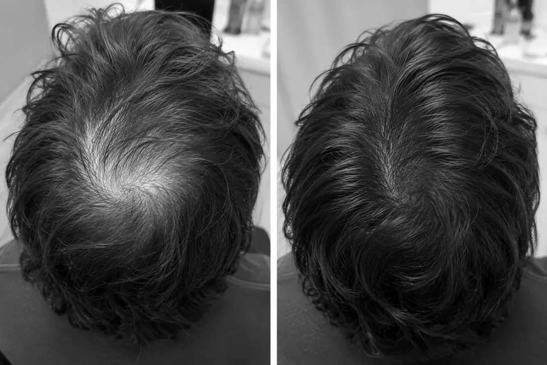 Before and after PRF hair restoration, crown view