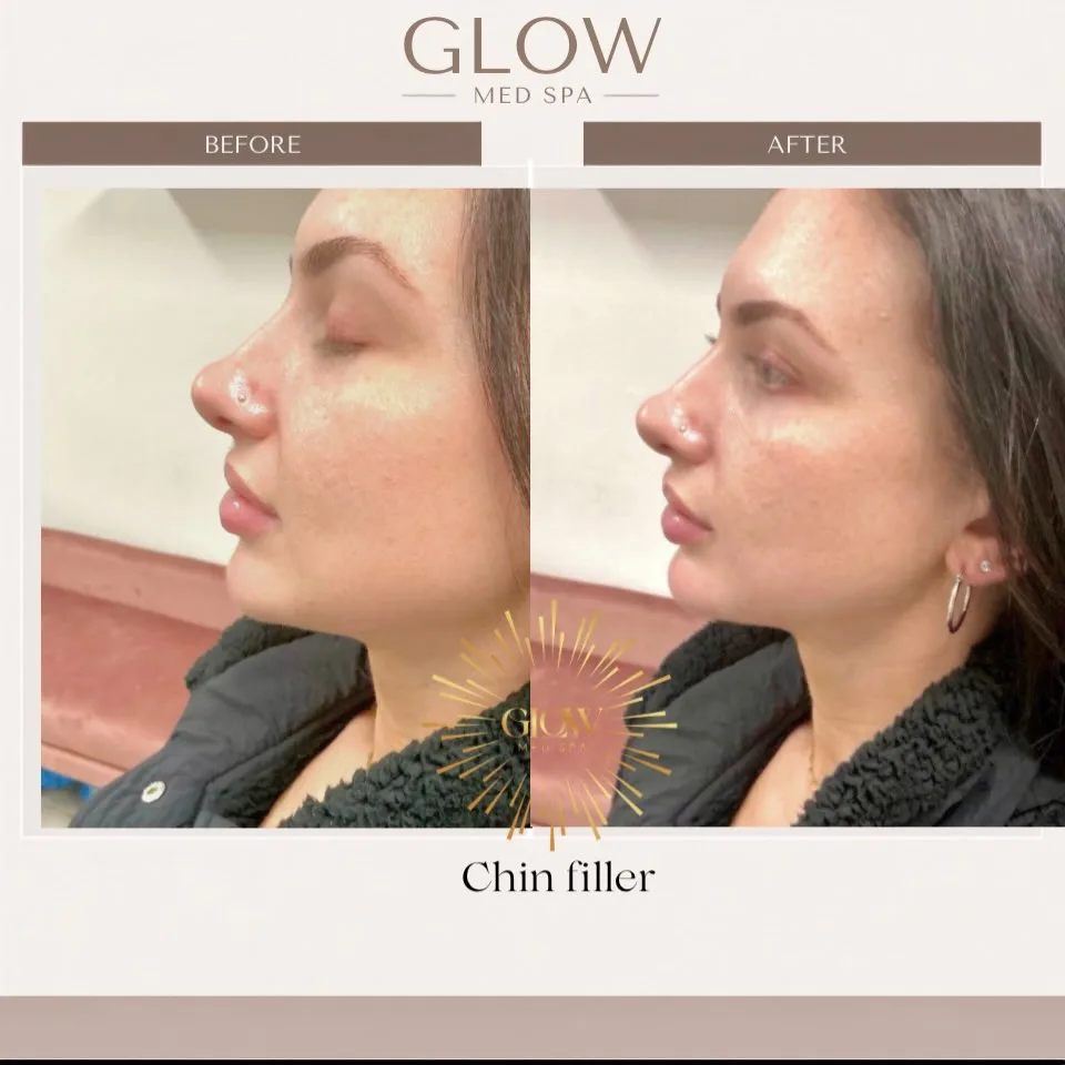Before and after chin filler, side profile