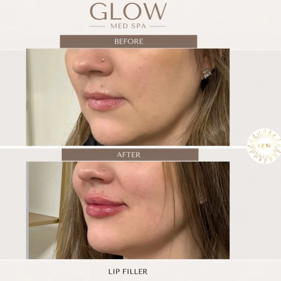 Before and after lip filler